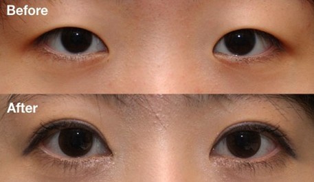 开眼角术后