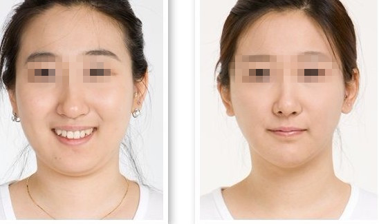 下颌角整形,长春整形,铭医