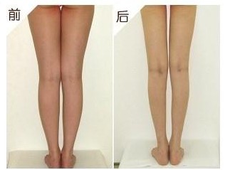 botox瘦腿,长春微整形,吉林铭医