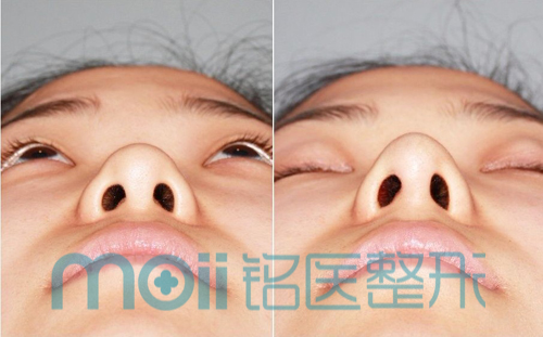 在对鼻子进行仰视观察时,美学上的标准鼻尖应该呈锥体状存在,对于