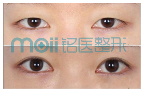 开眼角,对比图,长春好的整形医院