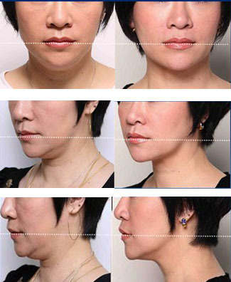 双下巴,对比图,长春好的整形医院