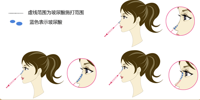 玻尿酸,隆鼻,过程,长春好的整形医院