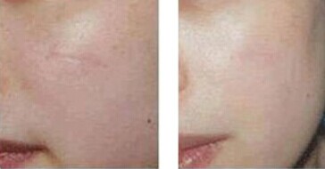 激光祛疤对皮肤有影响吗？