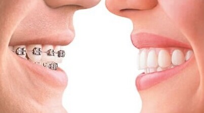 牙齿矫正 将对你的脸形有一定影响