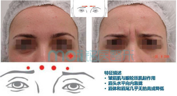 特征描述:   皱眉肌和降眉间肌,内侧眼轮匝肌起主要作用;   眉头中