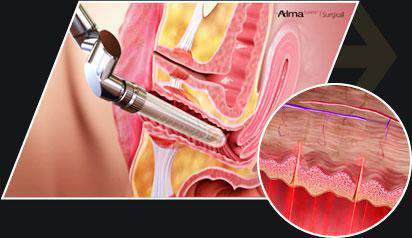 菲蜜丽,激光,私密,优点,长春好的整形医院