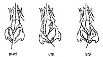 歪鼻,类型,长春好的整形医院