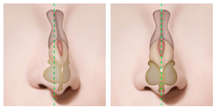 什么是歪鼻,长春好的整形医院