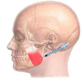 瘦脸针,咬肌肥大,注射原理,长春好的整形医院