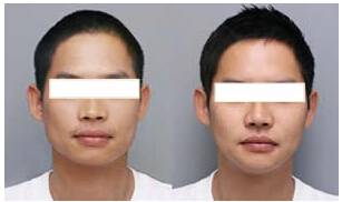 只需一针 轻松让男人瘦脸