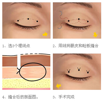 埋线双眼皮,步骤,长春好的整形医院