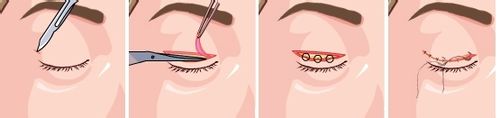双眼皮手术方法有几种