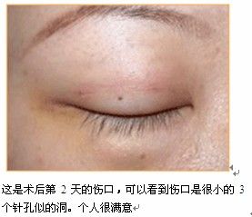韩式三点双眼皮 精准定位没有疤痕微创消肿快(图)