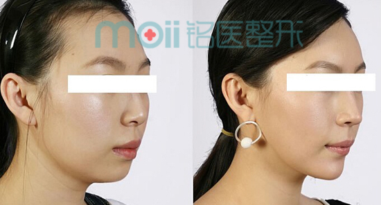丰下巴,对比图,长春好的整形医院