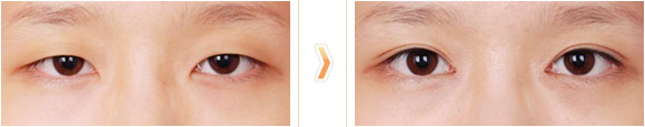 显微灵动双眼皮手术前后对比图