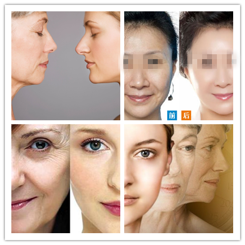 长春面部拉皮,长春拉皮除皱,去皱效果好吗