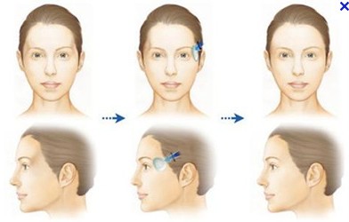 长春丰太阳穴,长春玻尿酸,长春爱贝芙
