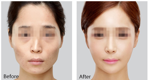 长春丰太阳穴,长春玻尿酸,长春爱贝芙