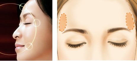 长春丰太阳穴,长春玻尿酸,长春爱贝芙