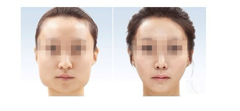 长春削骨瘦脸