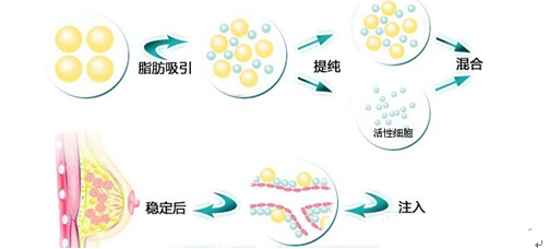 自体脂肪隆胸,长春丰胸,铭医