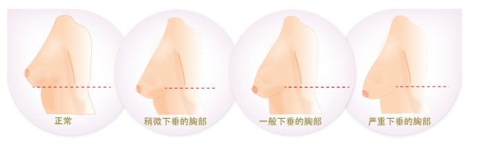 长春胸部整形,胸部下垂矫正