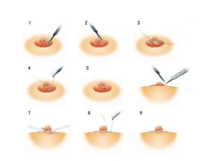 长春乳头再造,长春乳晕再造,长春乳头乳晕