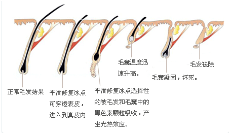 长春激光脱毛,长春冰点脱毛