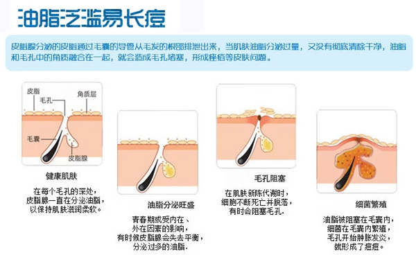 长春激光祛痘,祛痘多少钱