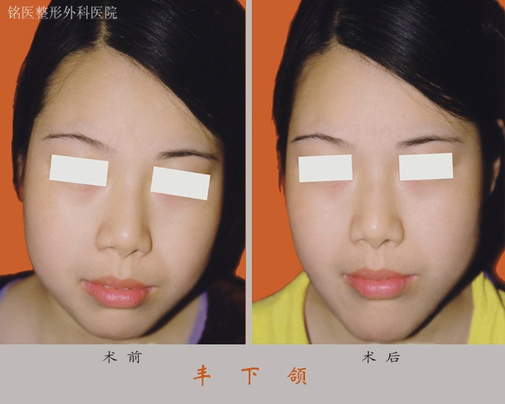 丰脸,对比图,长春好的整形医院