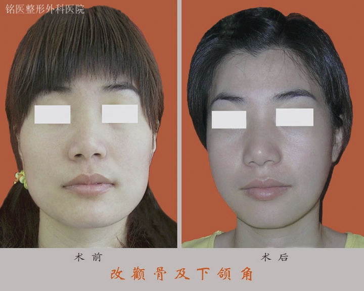 下颌角,对比图,长春好的整形医院