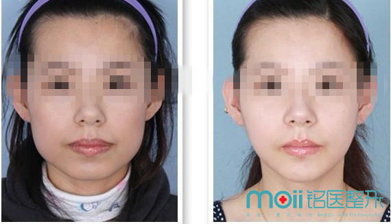 瘦脸,对比图,长春好的整形医院
