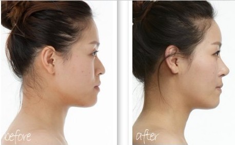 每个人的鼻子也都不尽相同,有的人的鼻子是鹰钩鼻,有的是驼峰鼻等