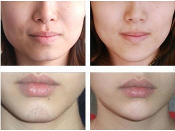 玻尿酸丰下巴,注射玻尿酸,铭医整形