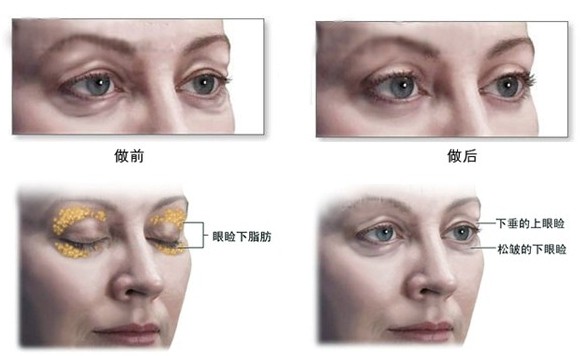 吸脂祛眼袋,眼部整形,长春铭医