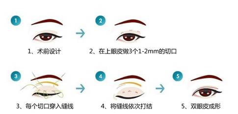 双眼皮手术方式,吉林铭医
