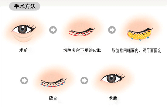 外切祛眼袋