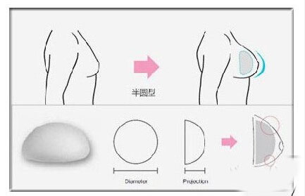隆胸假体