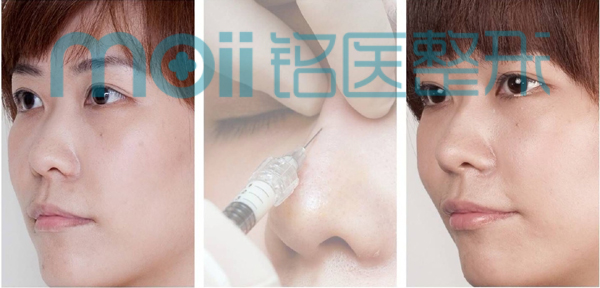 玻尿酸,隆鼻,对比图,长春好的整形医院