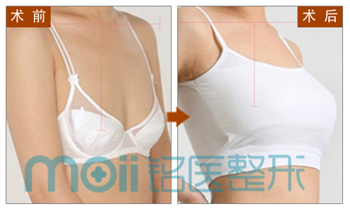 假体,丰胸,隆胸,对比图,长春好的整形医院