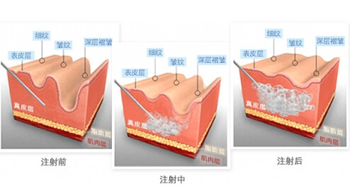 玻尿酸,护肤品,水平,档次,长春好的整形医院
