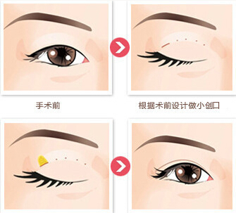 双眼皮,长春好的整形医院