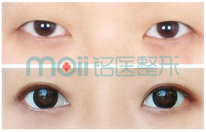 双眼皮,重睑术,对比图,长春好的整形医院
