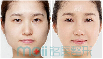 瘦脸,瘦脸针,对比图,长春好的整形医院