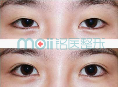 埋线双眼皮保持时间长不长?