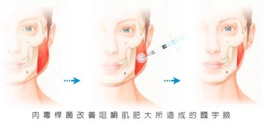 BOTOX,注射,瘦脸针,长春好的整形医院