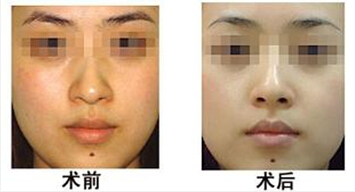 激光,美白,嫩肤,对比图,长春好的整形医院