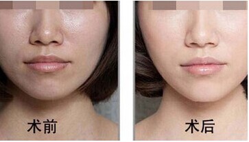 彩光嫩肤可以去除妊娠纹吗?