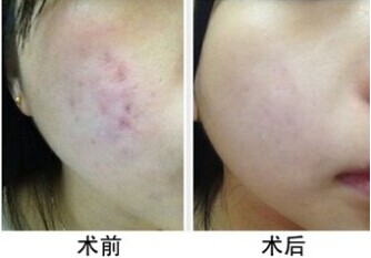 面对激光去痘印 你准备好了吗?